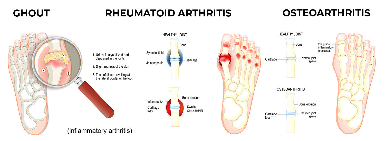 Gout, Rheumatoid arthritis, and Osteoarthritis -- Causes and Treatment