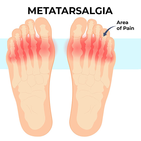 Metatarsalgia